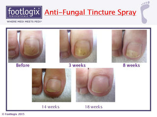 Footlogix | Toe Nail Tincture tegen schimmelnagel en verkleurde teennagels 50 ml