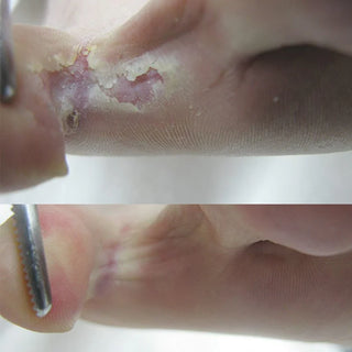 Footlogix | Peeling Skin Formula tegen vervellende voeten en voetschimmel 125ml